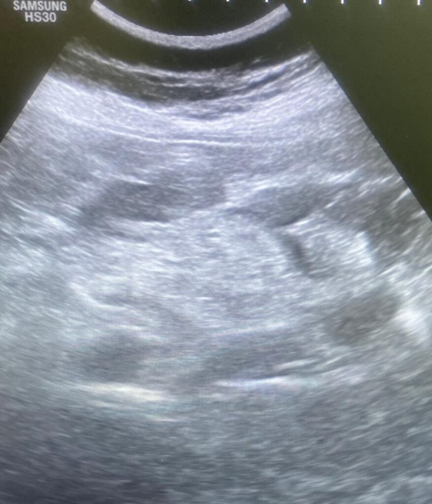 Pseudo Kidney Sign on Ultra Sonography: whatsapp image 2026 05 23 at 2.09.35 pm
