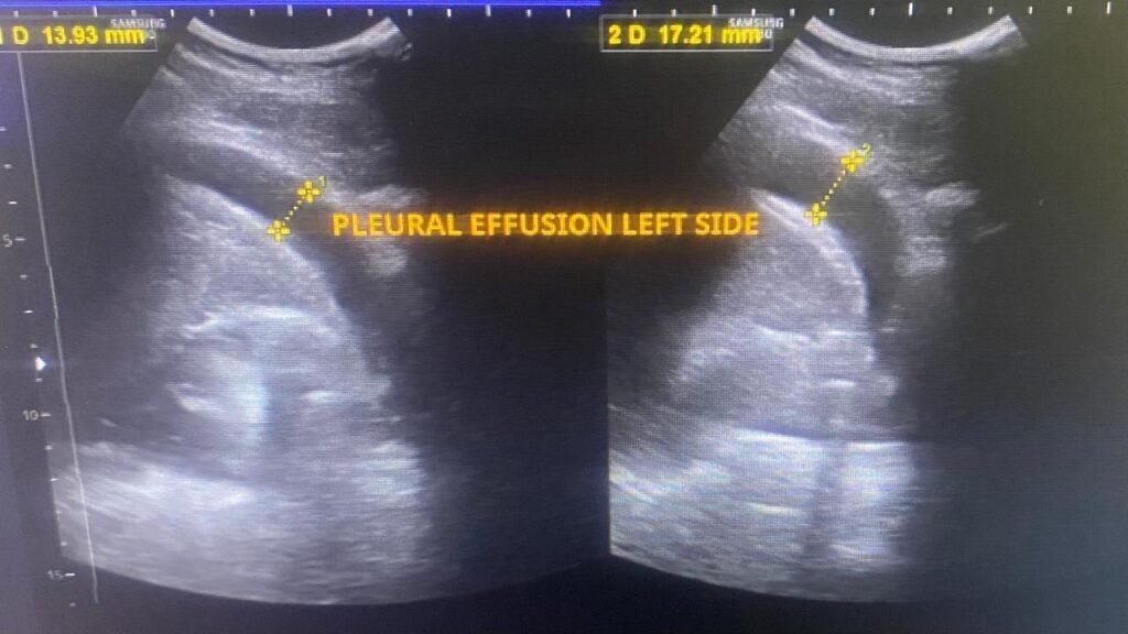 Pleural effusion diagnosis on ultra sound:- whatsapp image 2026 05 23 at 9.17.03 pm (1)
