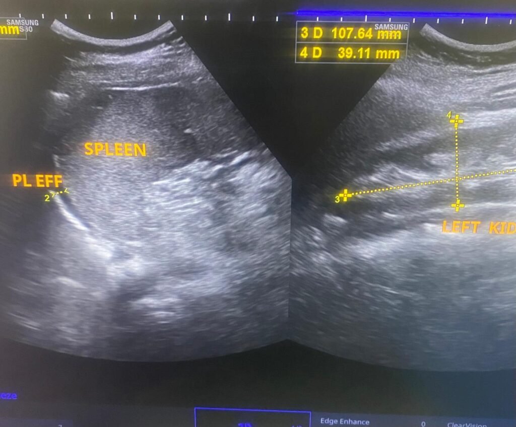 Pleural effusion diagnosis on ultra sound:- whatsapp image 2026 05 24 at 7.00.44 am